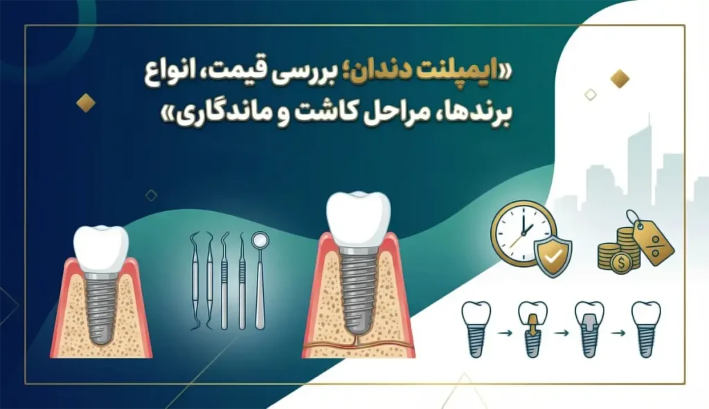 ایمپلنت دندان