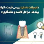 ایمپلنت دندان؛ بررسی قیمت، انواع برندها، مراحل کاشت  و ماندگاری