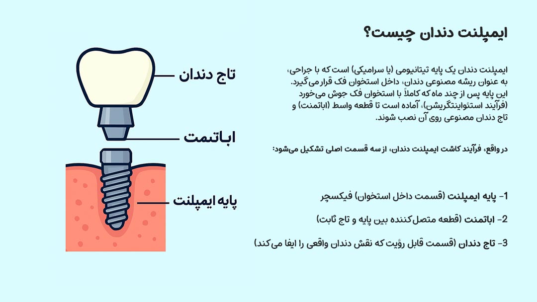 ایمپلنت دندان چیست؟