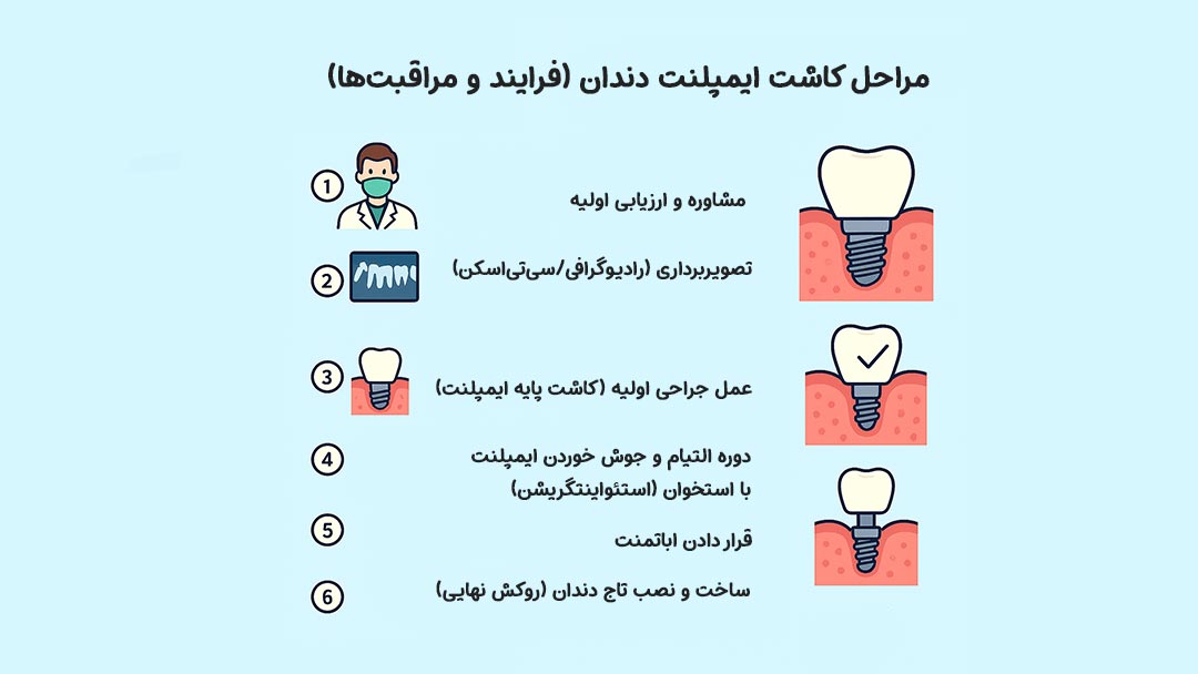 مراحل کاشت ایمپلنت دندان
