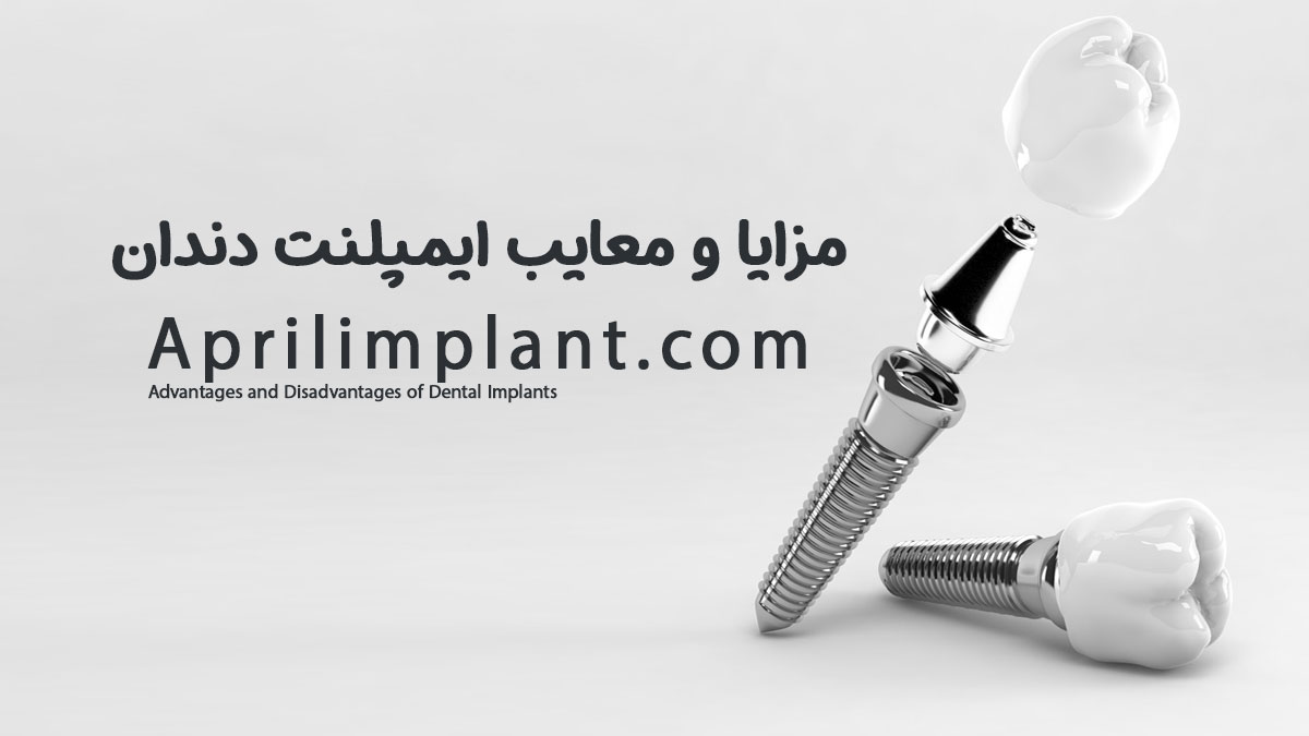 مزایا و معایب ایمپلنت دندان