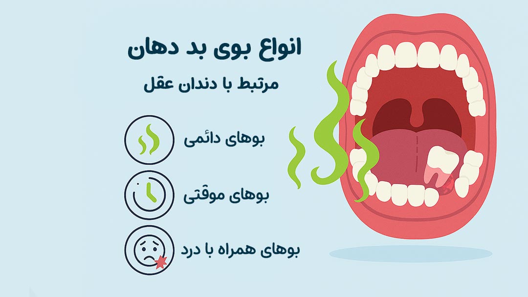 انواع بوی بد دهان مرتبط با دندان عقل