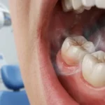 بوی بد دهان ناشی از دندان عقل؛ علت‌ها و درمان تخصصی