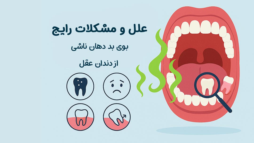 بوی بد دهان ناشی از دندان عقل