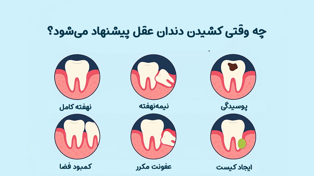 چه وقتی کشیدن دندان عقل پیشنهاد می‌شود؟
